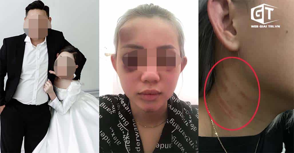 Yêu 4 năm rồi cưới, cô gái về làm vợ 2 tháng đã bị chồng bạo hành dã man: Đánh bầm mắt, bóp cổ không cho chạy khỏi nhà?
