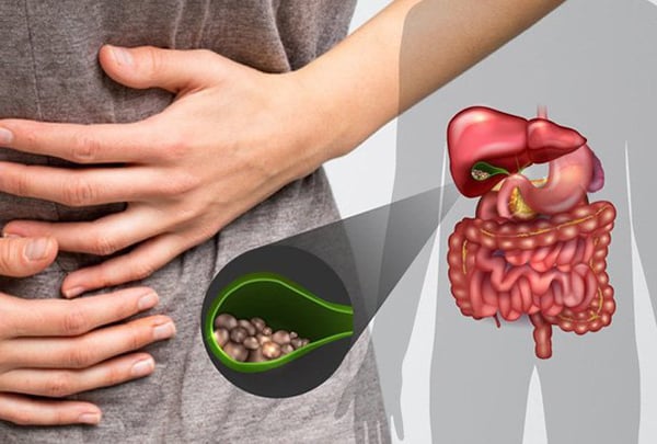 Biến chứng nguy hiểm của sỏi mật
