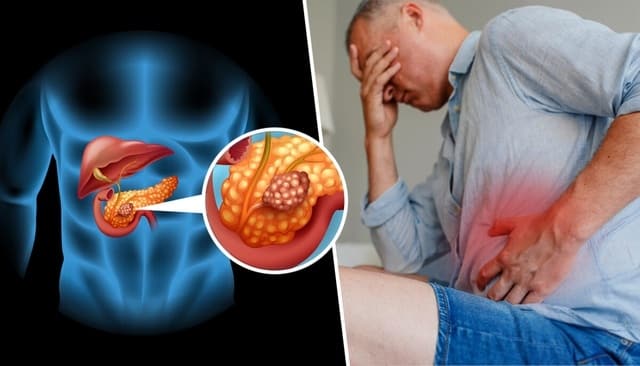 Nguyên nhân, triệu chứng và cách điều trị bệnh ung thư tuyến tụy