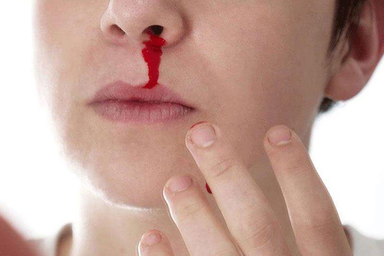 Ngạt mũi một bên, chảy máu mũi có thể là dấu hiệu của ung thư
