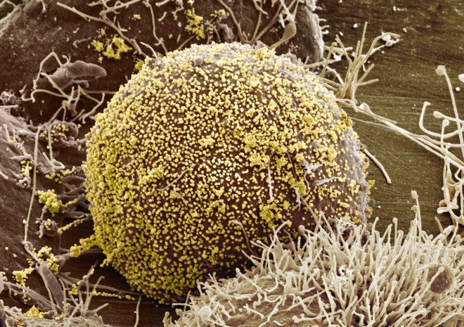 Nữ bệnh nhân HIV đầu tiên được chữa khỏi