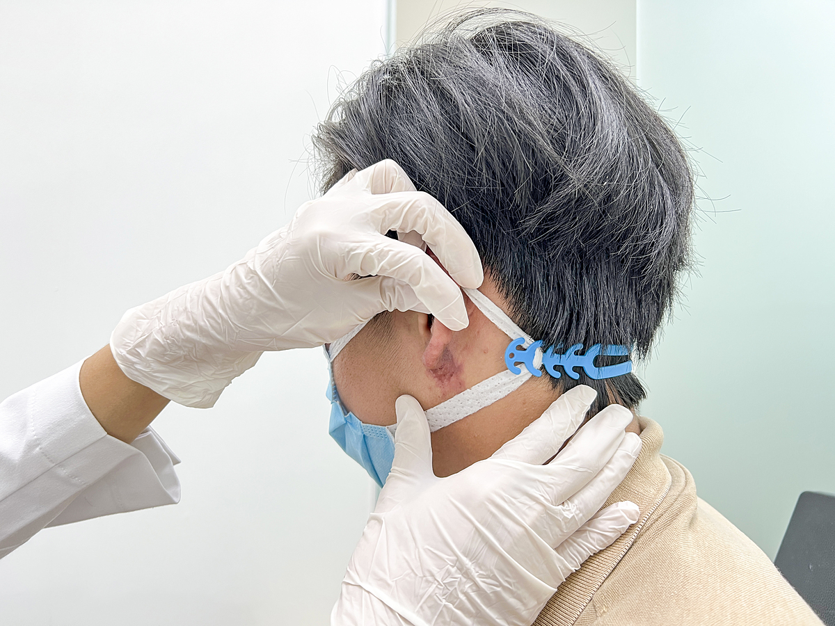 Tắc mạch, hoại tử da sau tiêm filler tạo ‘tai Phật’