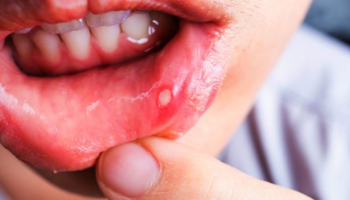 Cách chữa nhiệt miệng nhanh nhất, dễ thực hiện tại nhà