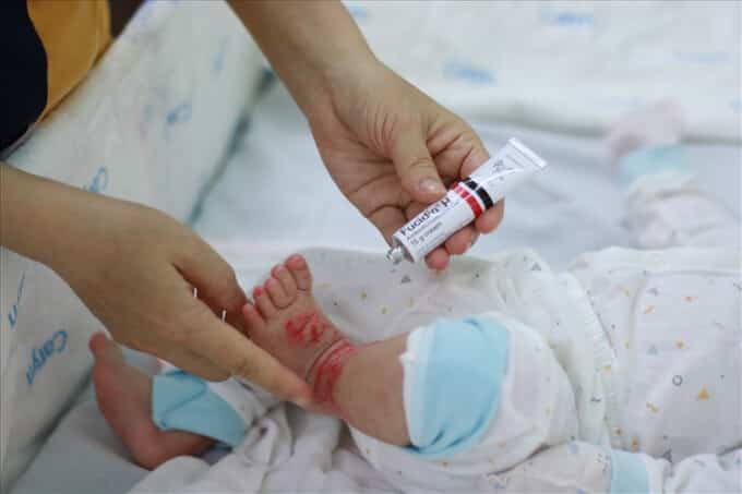 TP HCM: Nhiều trẻ nhập viện do viêm da cơ địa nặng