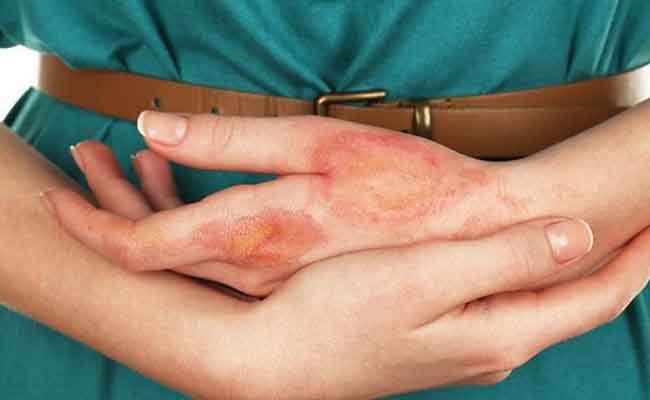 Các triệu chứng của bệnh tiểu đường trên da