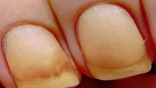Nguyên nhân, triệu chứng, biến chứng, chẩn đoán và điều trị hội chứng móng tay vàng
