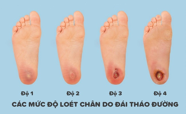 Bộ Y tế ban hành “Hướng dẫn chẩn đoán, điều trị loét bàn chân do đái tháo đường”