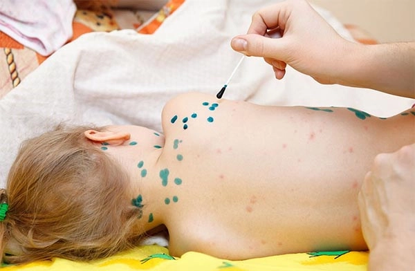 Những thông tin cần biết về bệnh thuỷ đậu