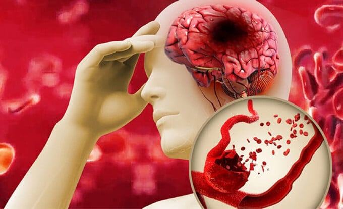 Chuyên gia khuyến cáo cách xác định người bị đột quỵ và uống nước đúng cách vào mùa hè