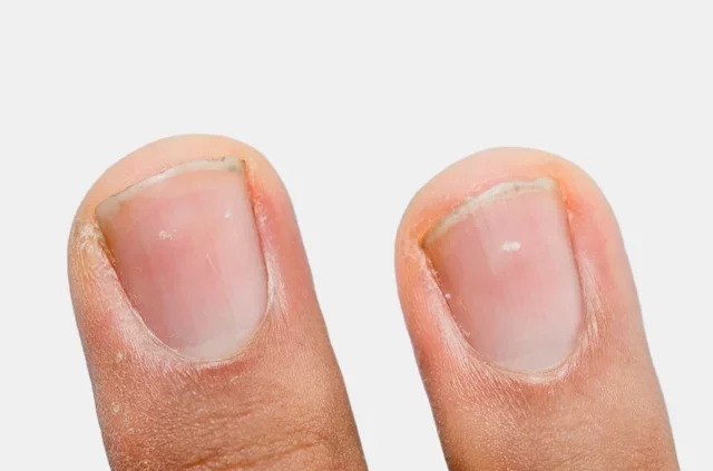 Nguyên nhân và cách trị đốm trắng trên móng tay