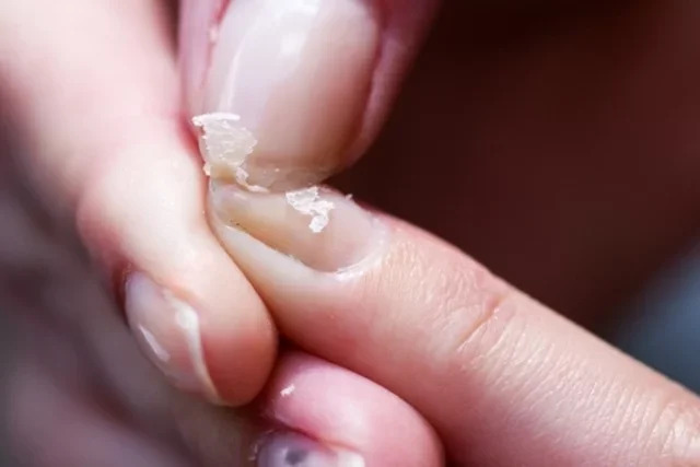 11 thay đổi trên móng tay có thể chỉ ra vấn đề sức khỏe