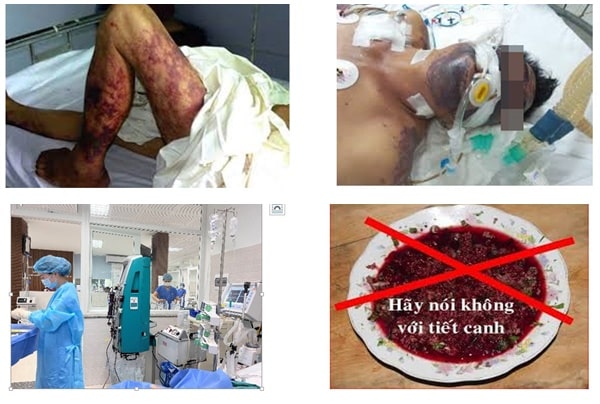 Tính mạng nguy hiểm khi mắc liên cầu khuẩn lợn: Hãy nói không với tiết canh lợn, thịt lợn sống, thịt lợn ốm, thịt lợn chết