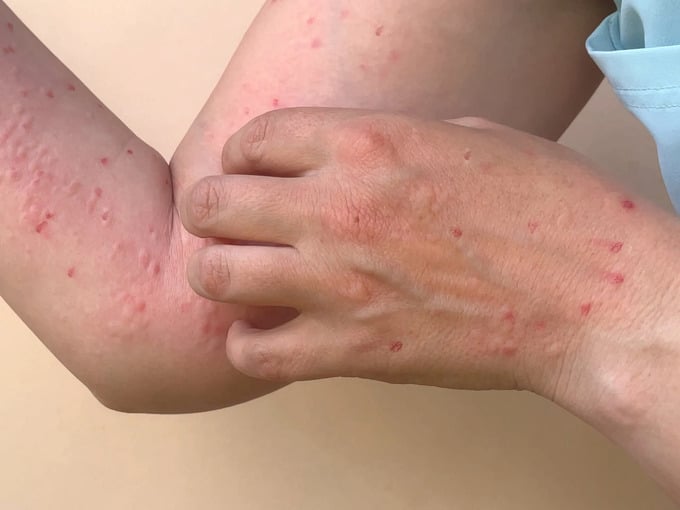 TP. Hồ Chí Minh đã phát hiện 63 trường hợp mắc đậu mùa khỉ từ tháng 9 đến nay