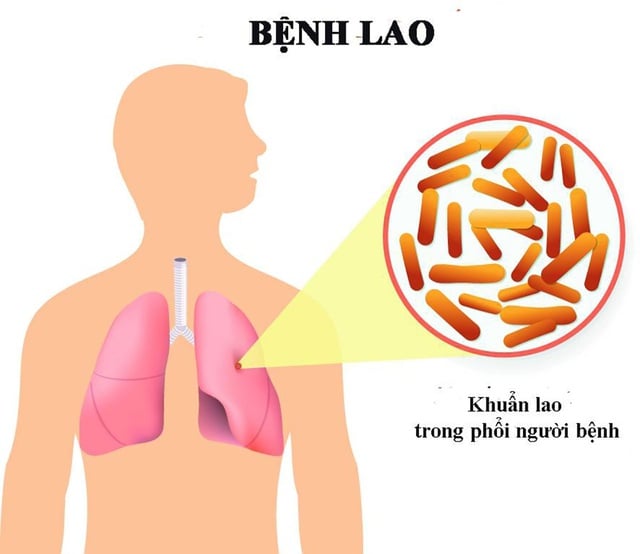 Thủ tướng chỉ đạo tăng cường công tác phòng, chống bệnh Lao