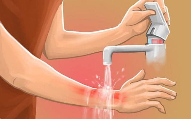 Những cách sơ cứu bỏng rất sai lầm, dễ gây nhiễm khuẩn vết thương