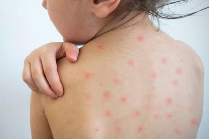 Hà Nội tăng cường công tác phòng, chống bệnh Sởi