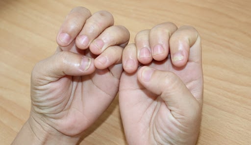 Triệu chứng, nguyên nhân, cách điều trị nấm móng tay