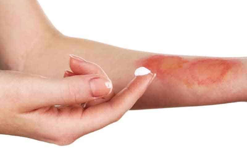 Quảng Ninh: Cảnh báo nhiều trường hợp bị bỏng do tai nạn sinh hoạt