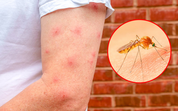 Mẹo đơn giản để giảm ngứa do muỗi đốt tại nhà