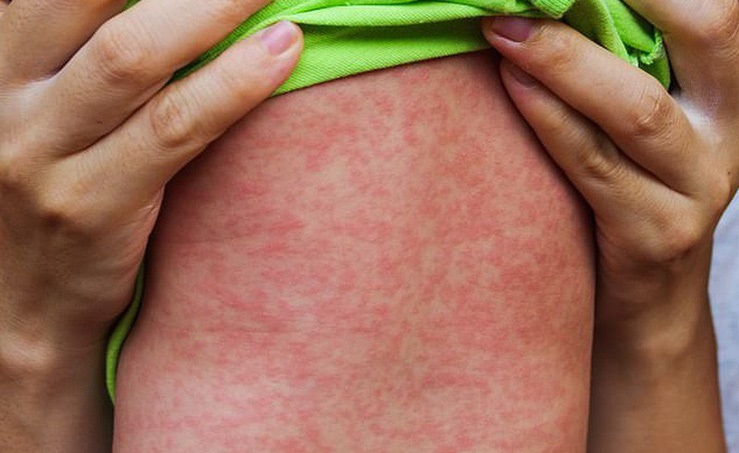 Thông tin về tình hình dịch bệnh sởi