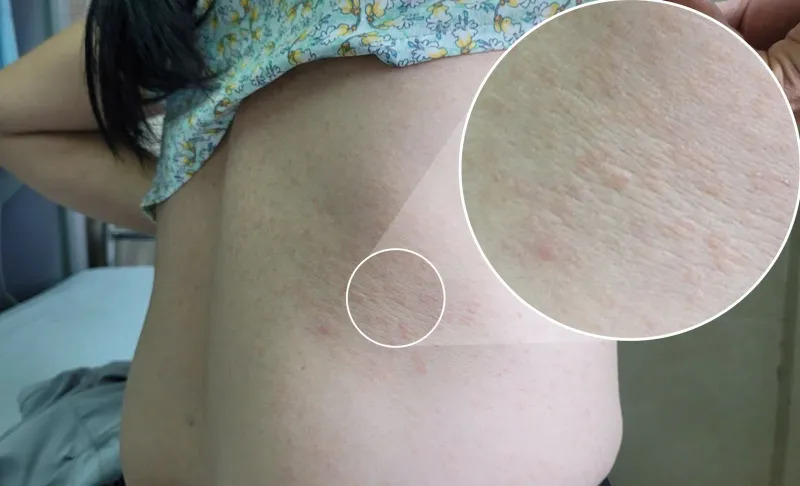 Phú Thọ: Điều trị cho bệnh nhân mắc giun đũa chó mèo
