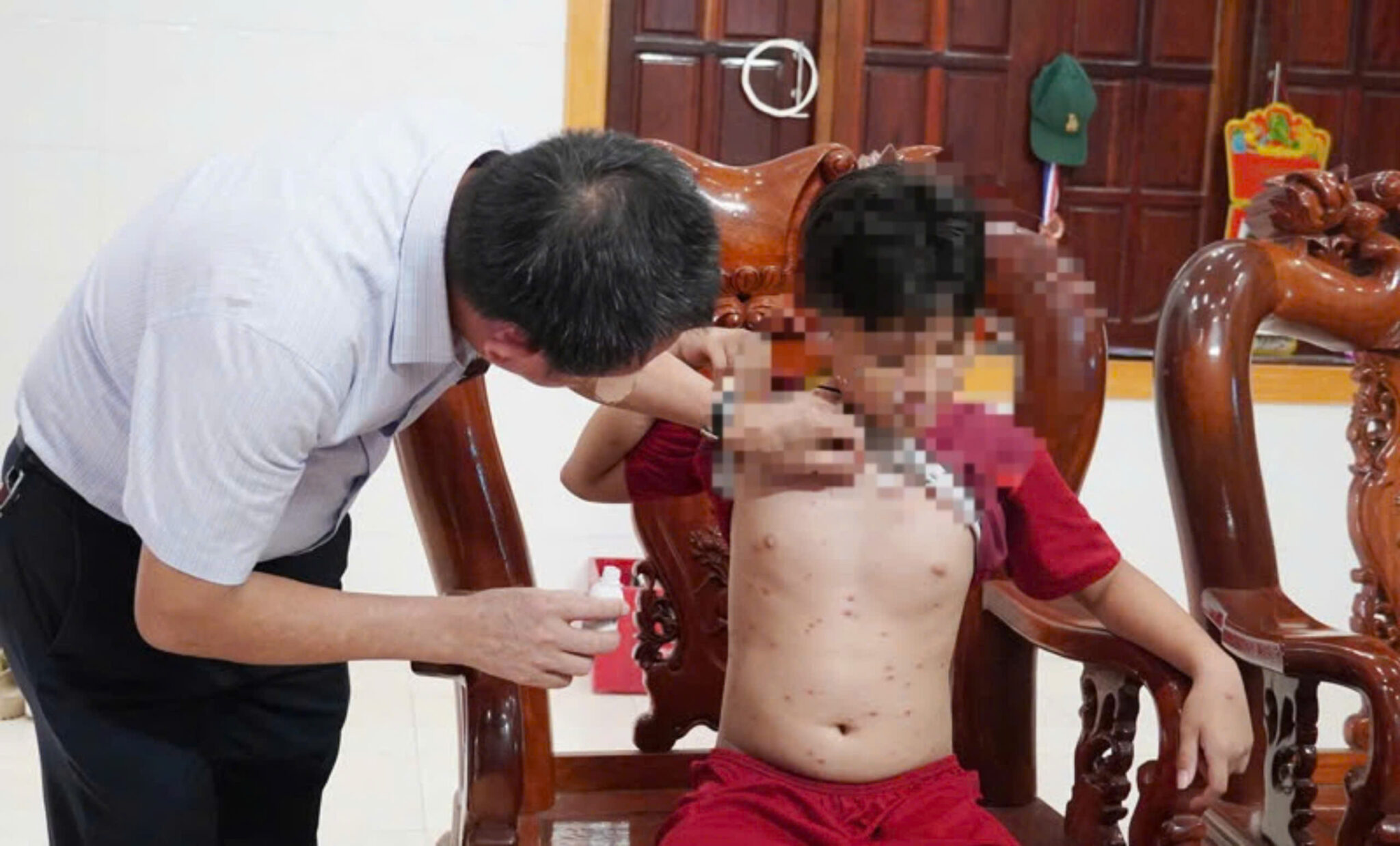 Quảng Bình: Một trường học có nhiều học sinh mắc thủy đậu