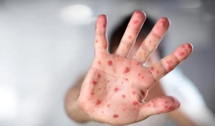 Bà Rịa – Vũng Tàu: Đã có trường hợp tử vong do bệnh sởi