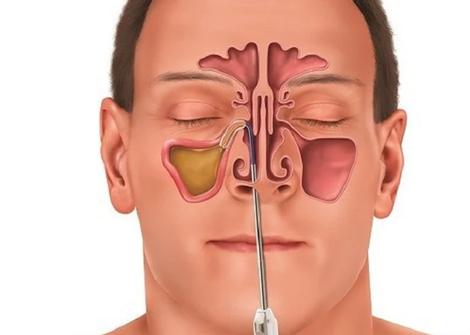 Tự ý điều trị viêm xoang có thể dẫn đến biến chứng nguy hiểm