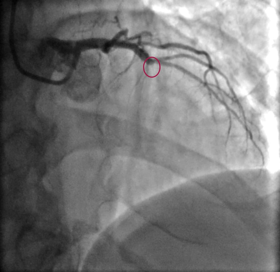 Cứu sống bệnh nhân bị nhồi máu cơ tim bằng can thiệp nong và stent mạch vành