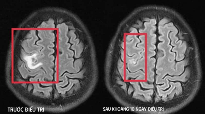 Tổn thương não do ký sinh trùng: Cảnh báo từ ca bệnh dễ nhầm u não