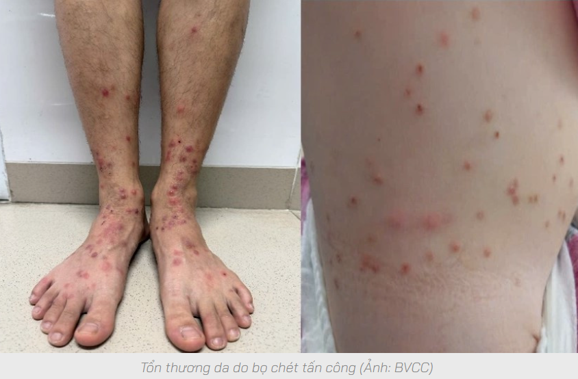 Miền Bắc ghi nhận nhiều ca sẩn ngứa do bọ chét trong mùa nóng