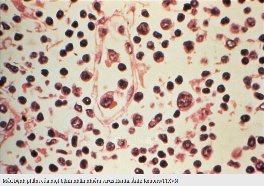 Virus Hanta: Xác nhận 6 ca nhiễm, nguy cơ lây lan toàn cầu ở mức thấp