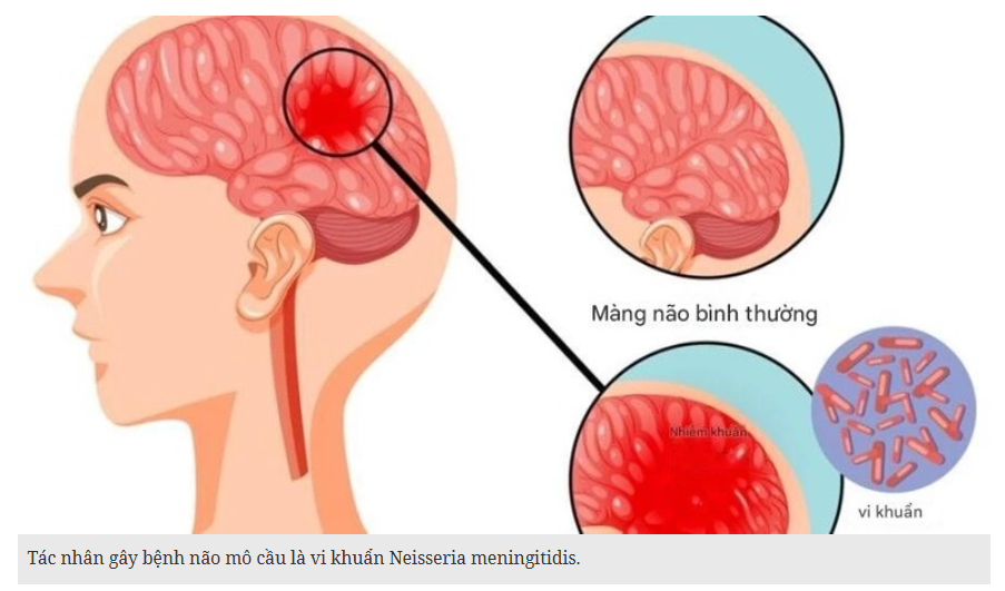 Bệnh não mô cầu có thể gây tử vong nhanh, chuyên gia cảnh báo những dấu hiệu nguy hiểm